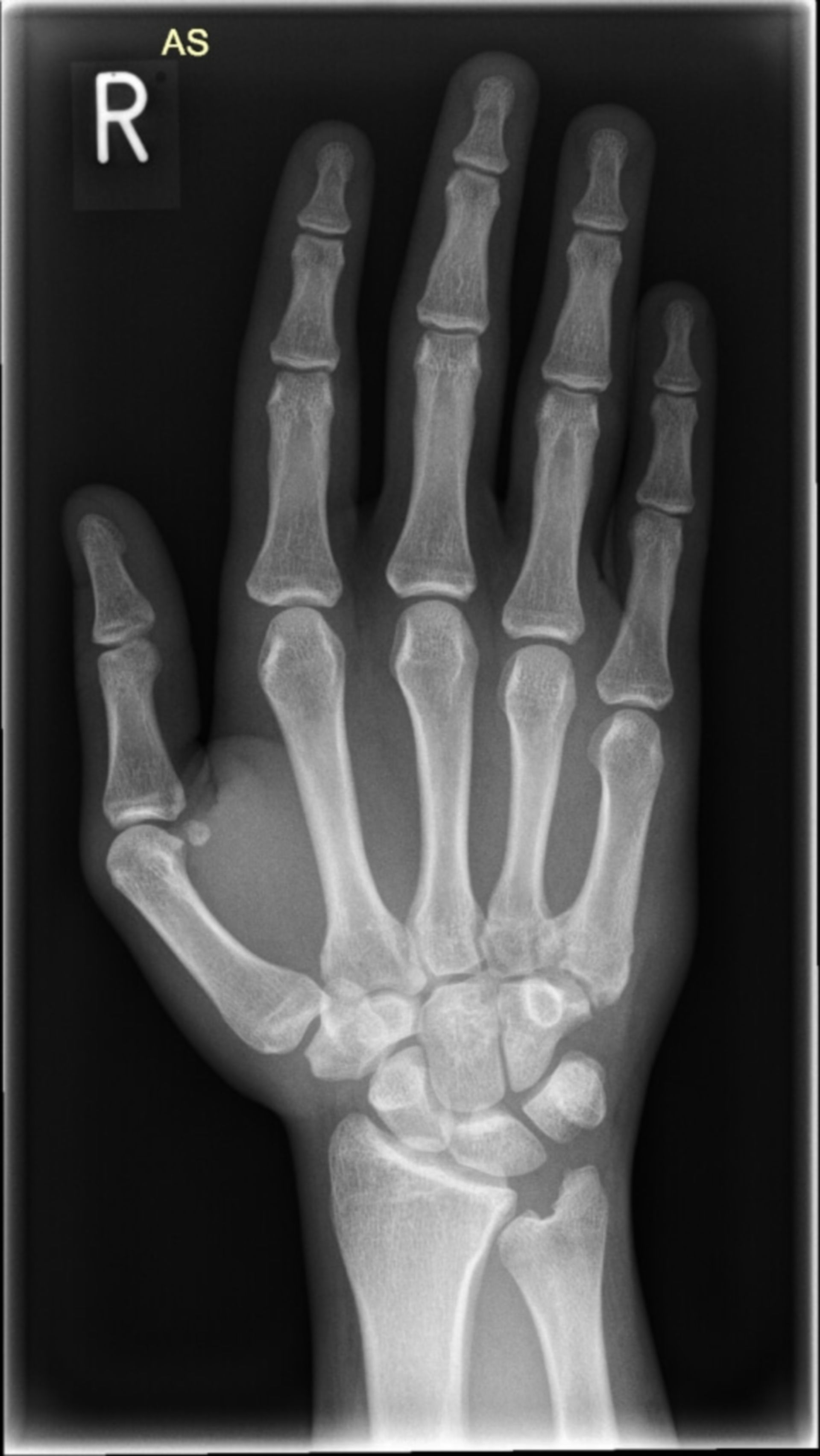 Röntgenaufnahme Hand