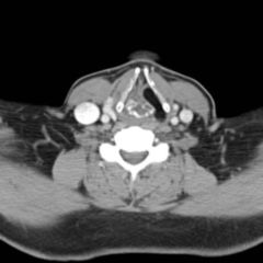 Endolaryngeal DocCheck Flexikon