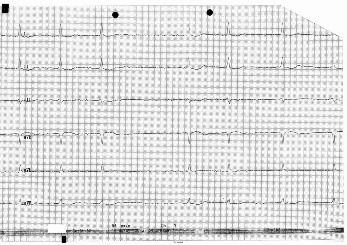 EKG: AA bei VHF, muldenförmige ST-Senkung vereinbar mit hohem Digitalisspiegel
