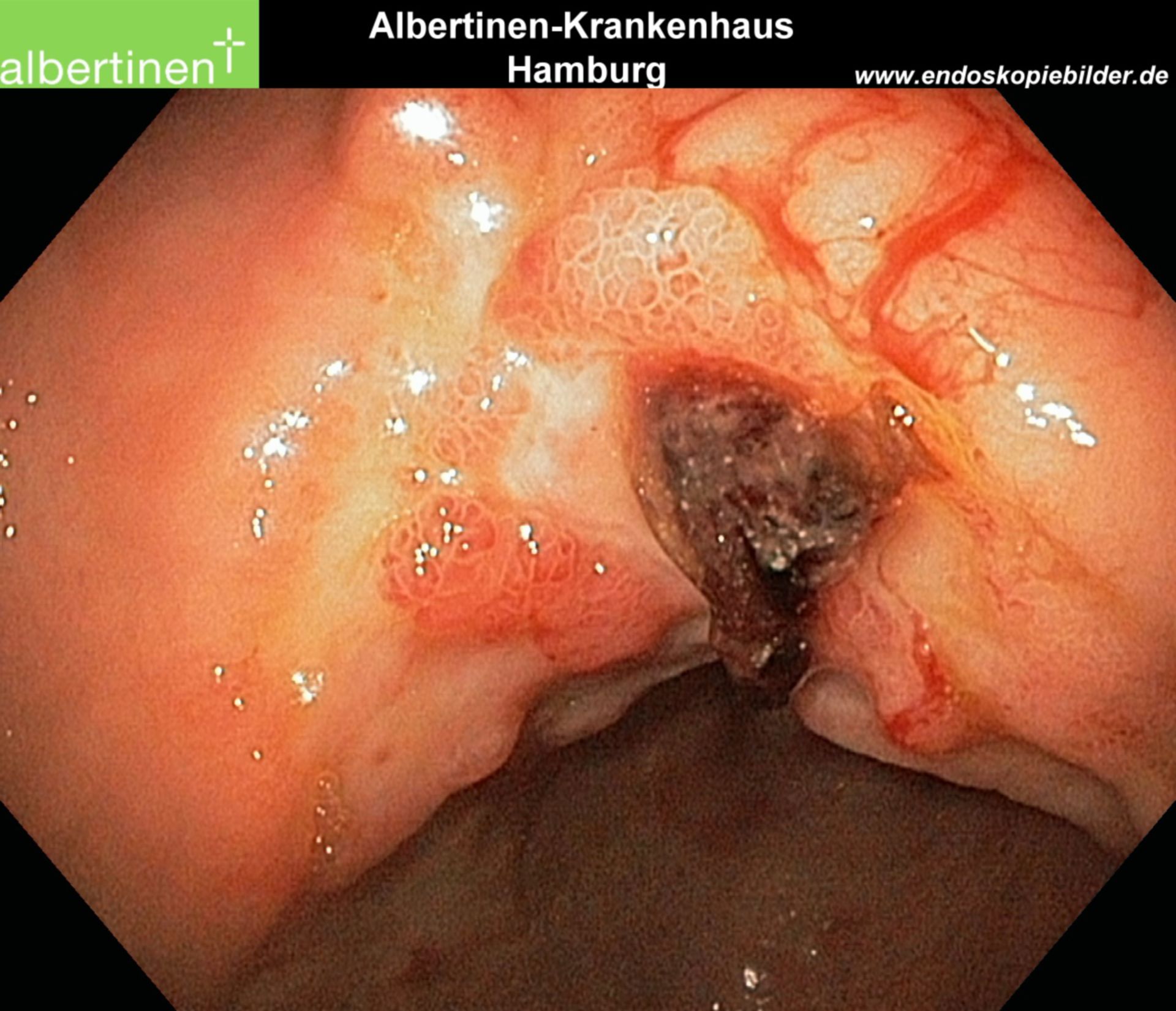 Endoscopy: Forrest 2b hemorrhage