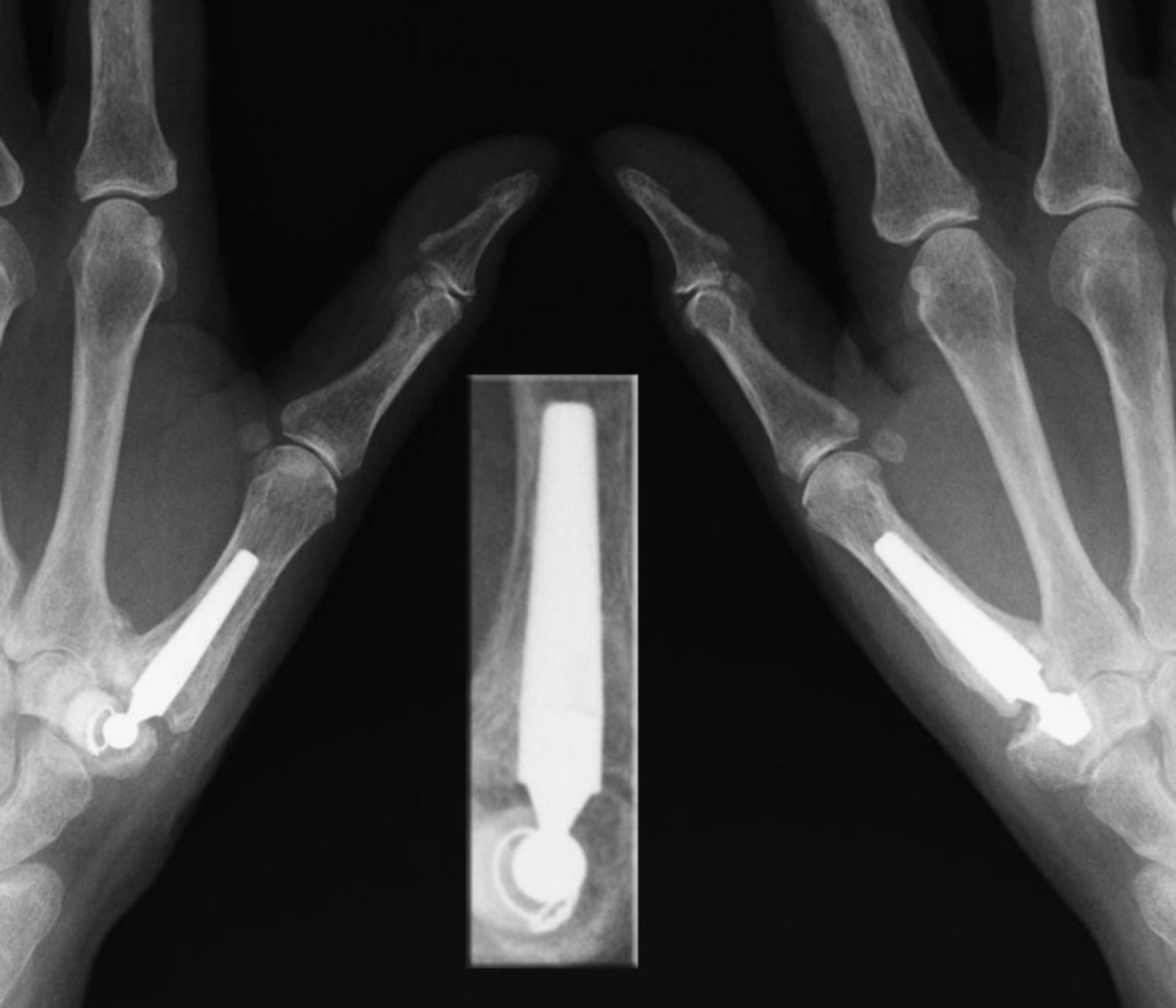 Endoprothesis of the carpometacarpal joint of the thumb