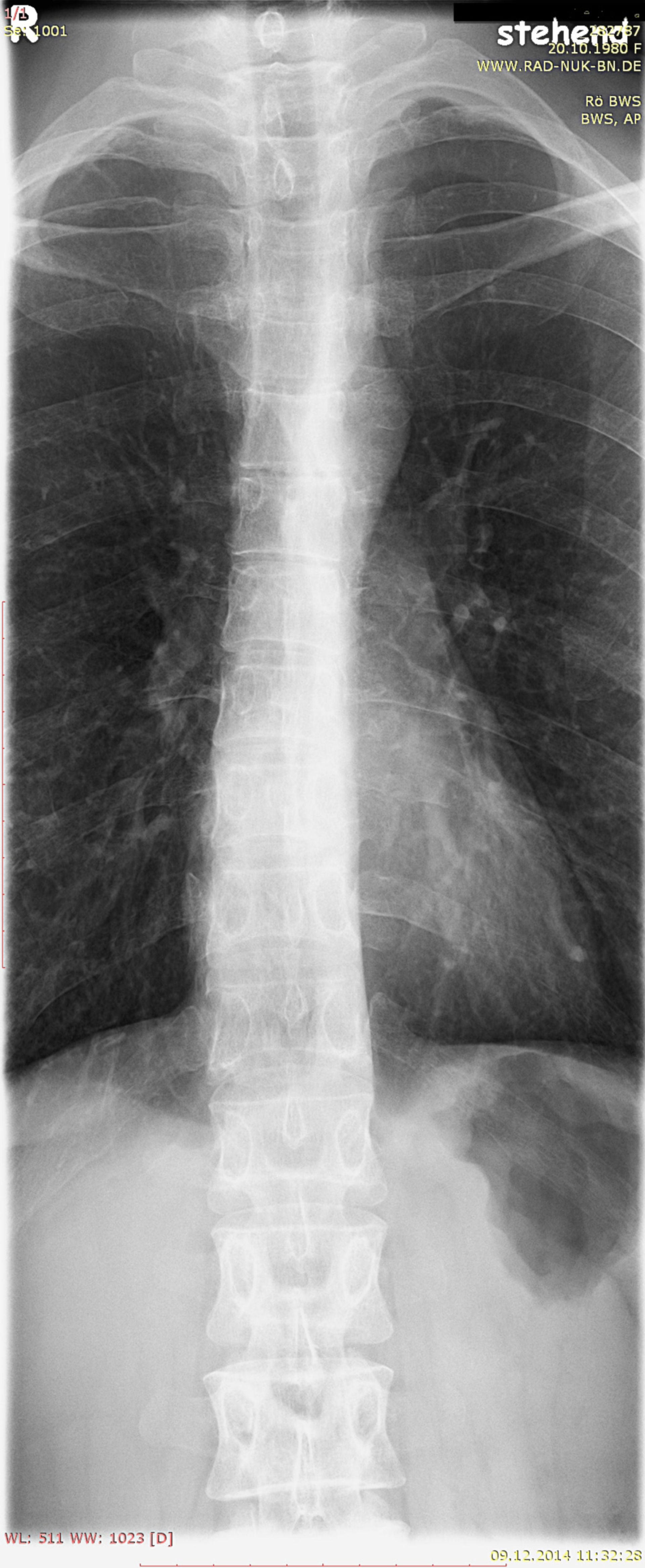 X-ray thorax 3