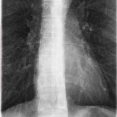 Röntgen-Thorax - DocCheck Flexikon