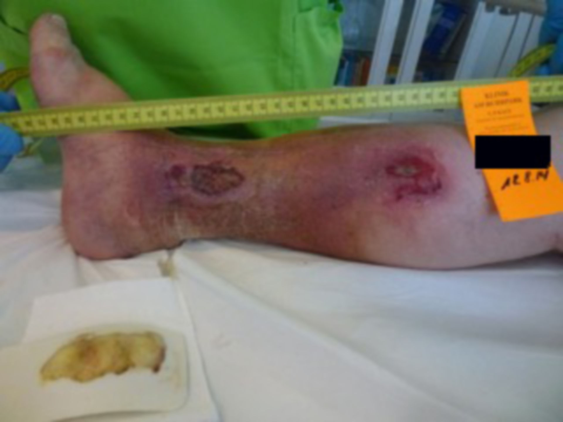 Ulcer of the lower leg - open for 18 months (2)