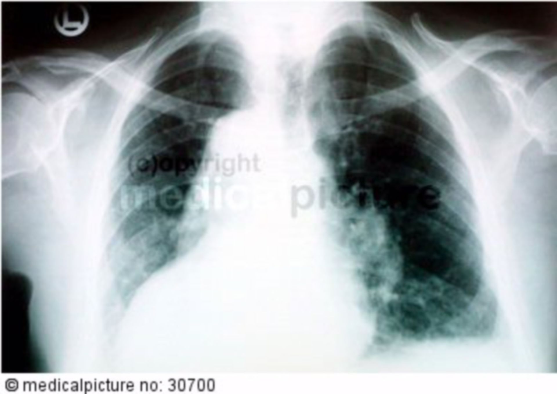 Röntgenbild vom Brustkorb