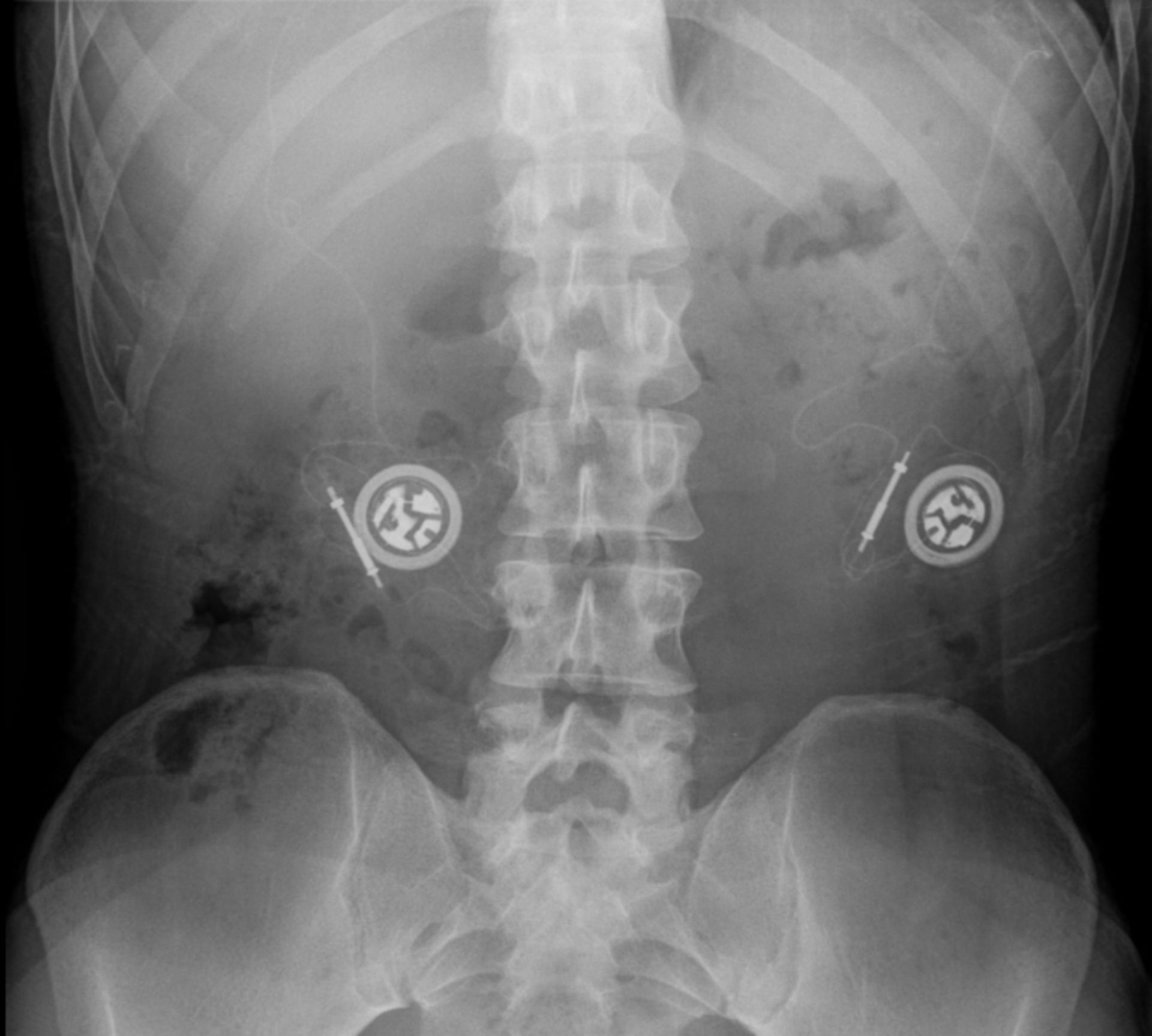 Pacemaker for the diaphragm in a patient with Ondine's curse