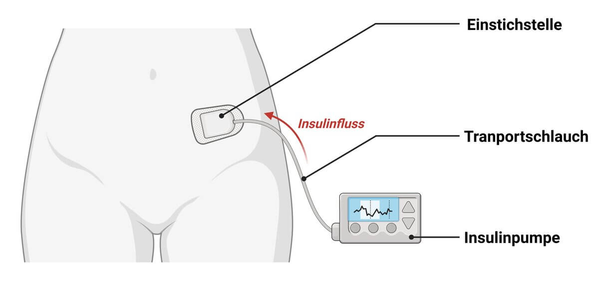 Aufbau einer Insulinpumpe