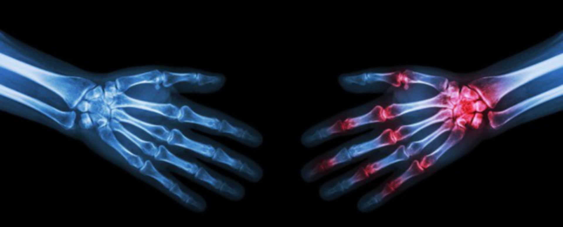 Rheumatoide Arthritis kann jeden treffen - DocCheck