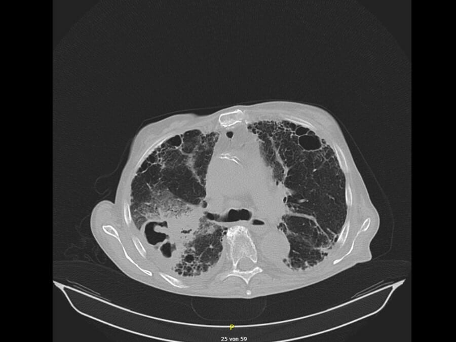 doccheck_-_07_-_komplexe_lungeninfektion_bild4_aspergillom_original.jpg