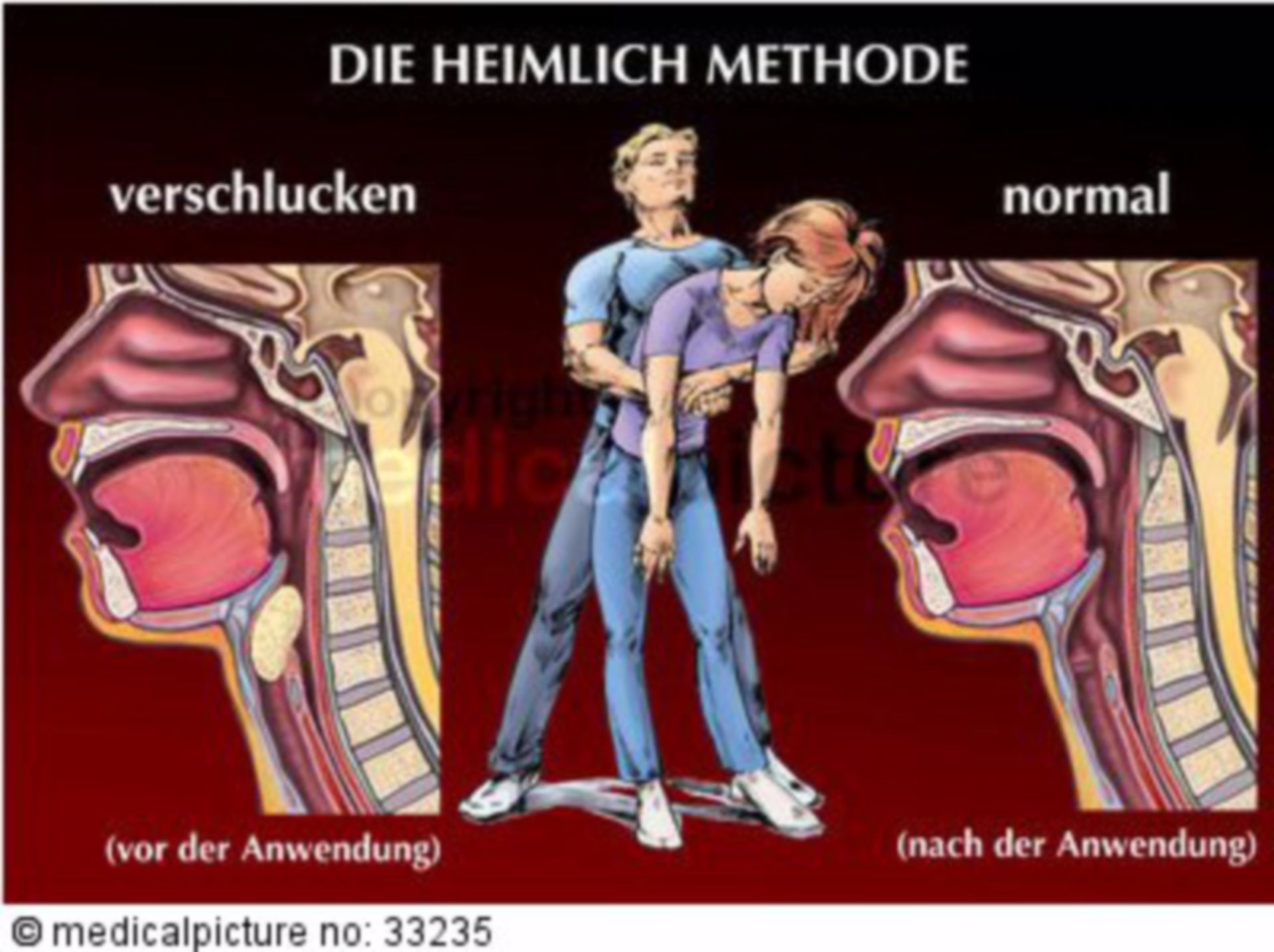  Heimlich-Handgriff Illustration 
