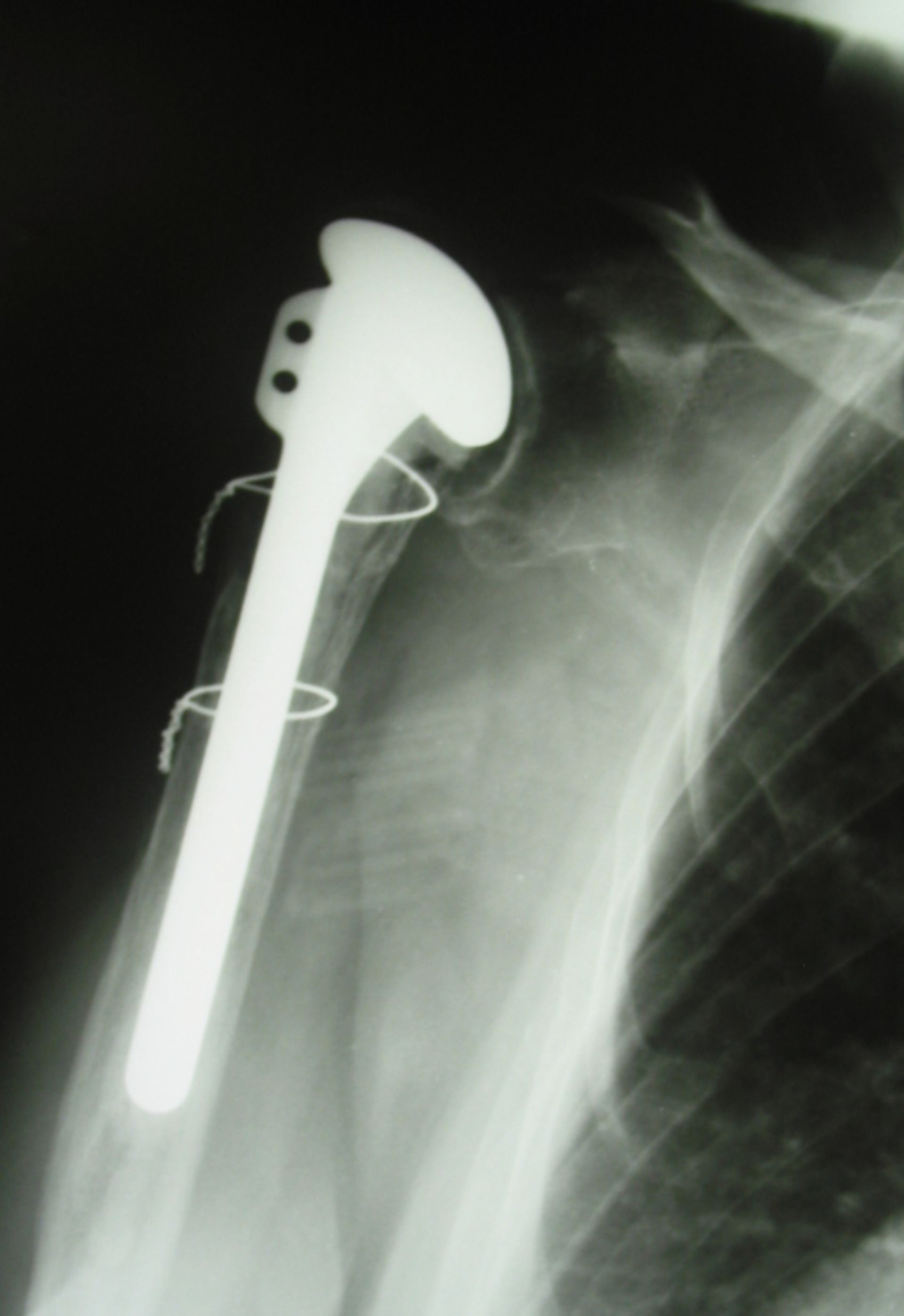 Humeral Head Prosthesis