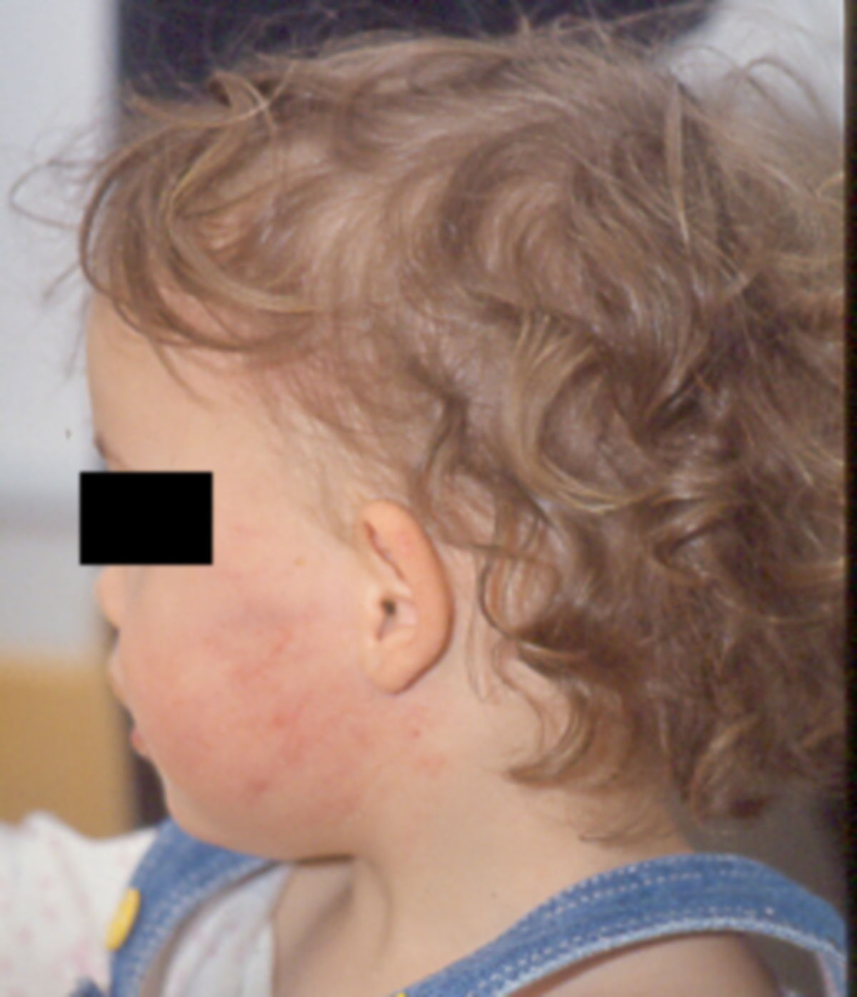 Sind Röteln Und Ringelröteln Das Gleiche Ohrfeige - DocCheck