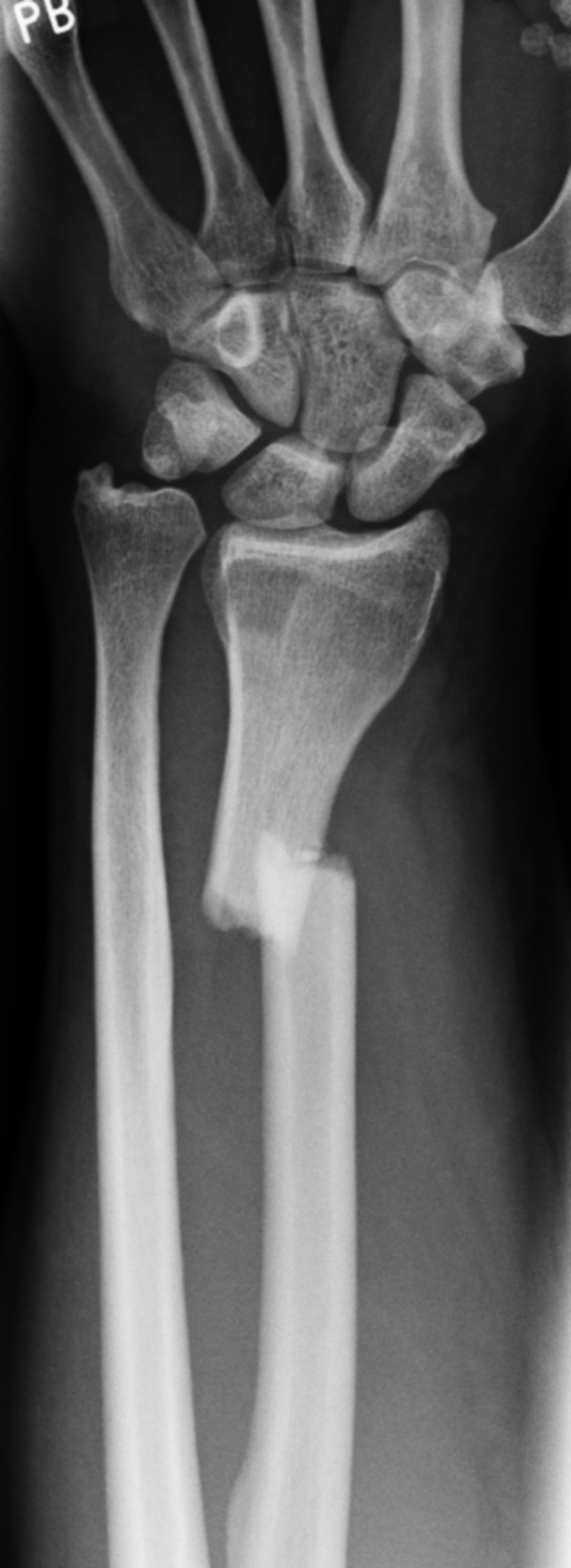 Radial fracture