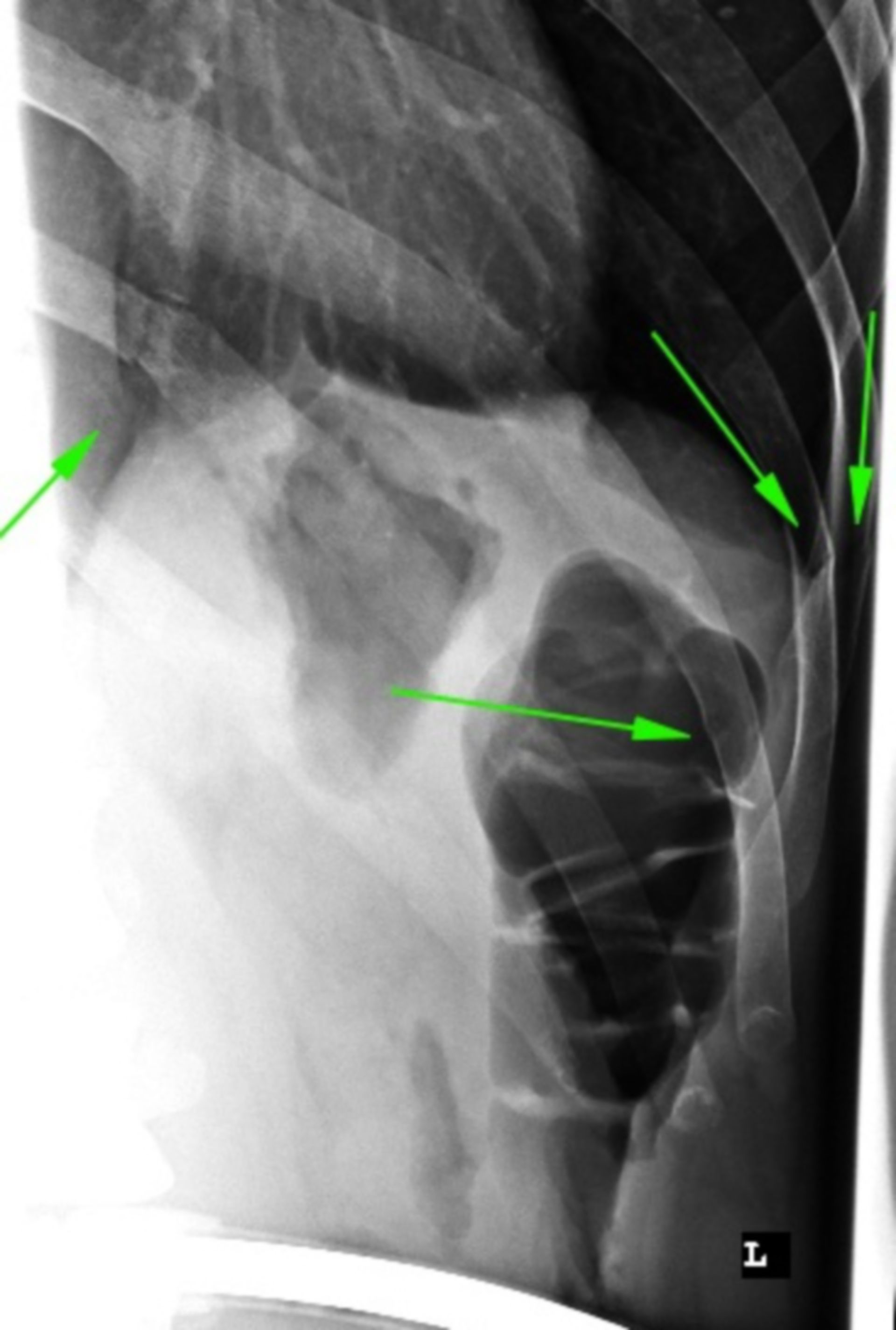 Rib fractures - hardly visible