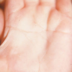 Vierfingerfurche DocCheck Flexikon