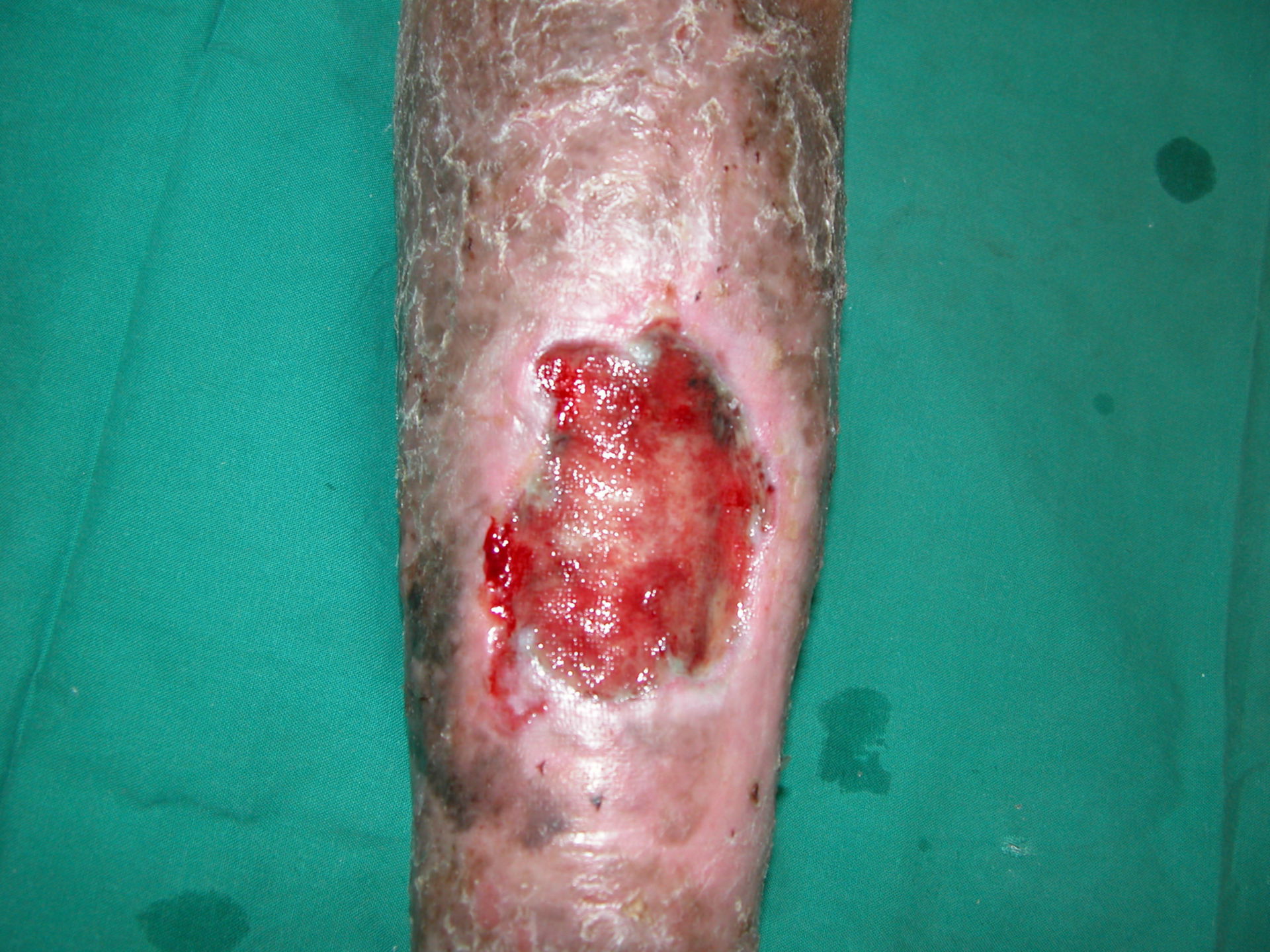 Vene varicose con ulcere. Iperpigmentazione, curata Dott. Ykshim. S Yonsei ospedale Seoul, Korea