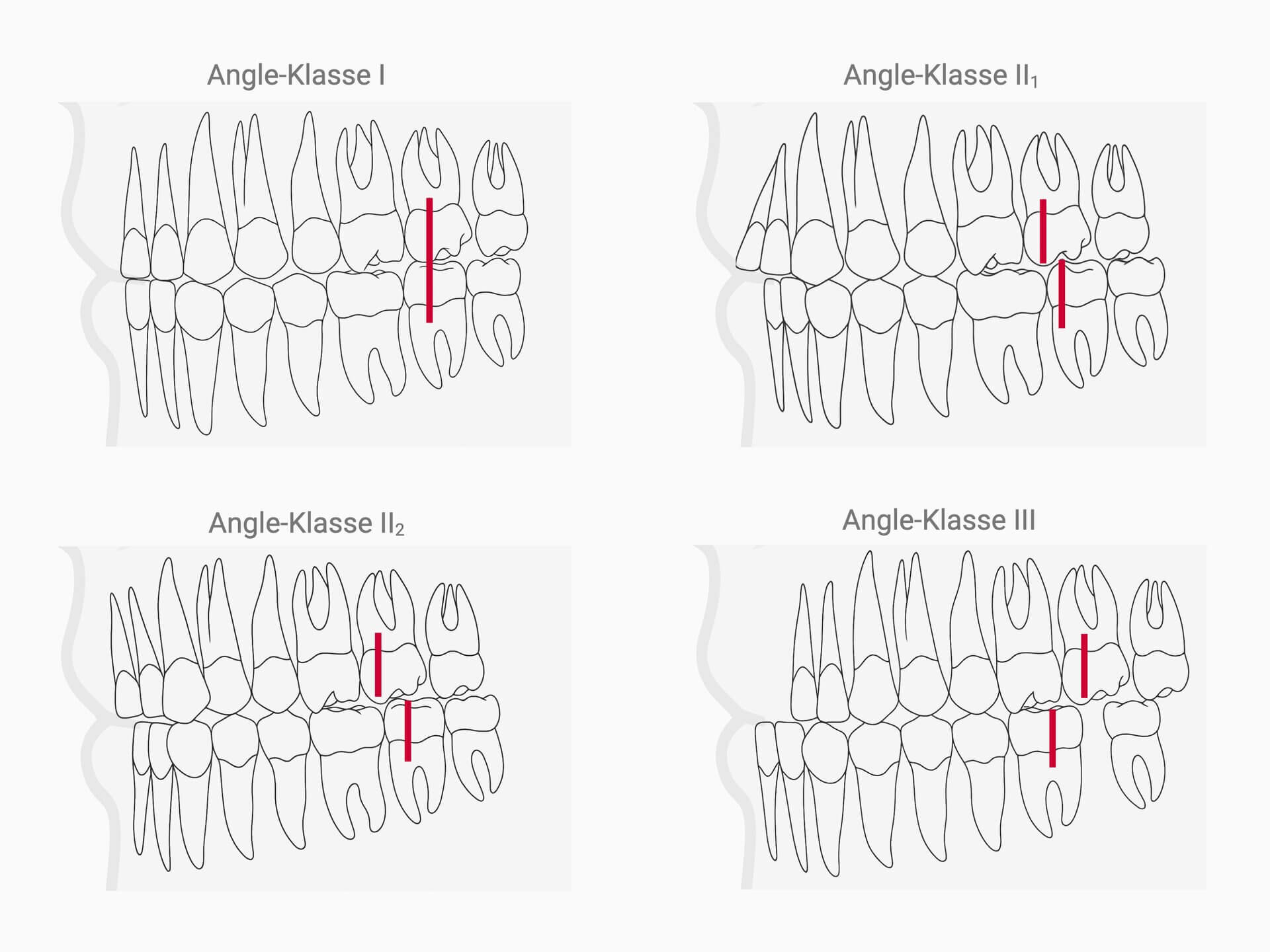 Angle-Klassifikation zur Einteilung von Zahnfehlstellungen