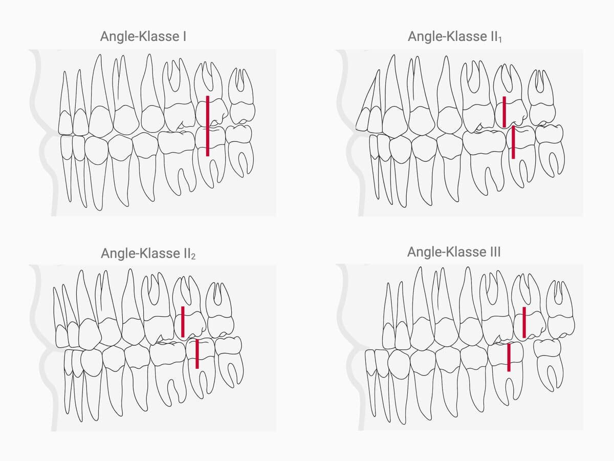 Angle-Klassifikation zur Einteilung von Zahnfehlstellungen