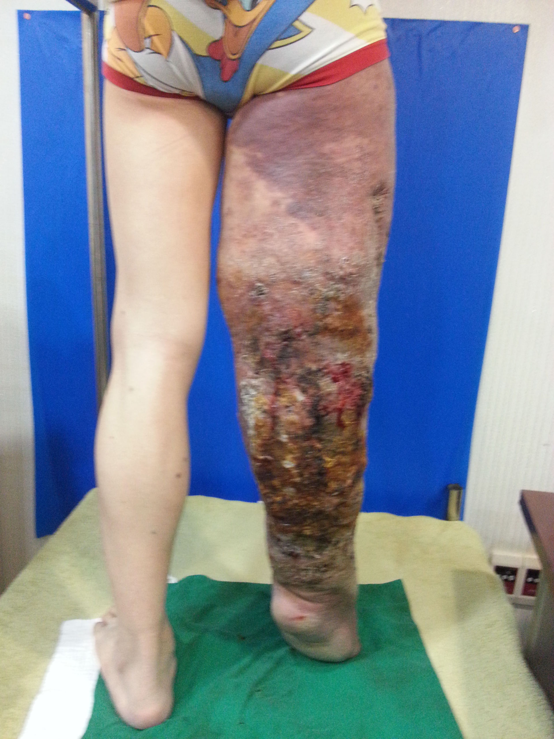 Patient with hyperkeratosis (2)