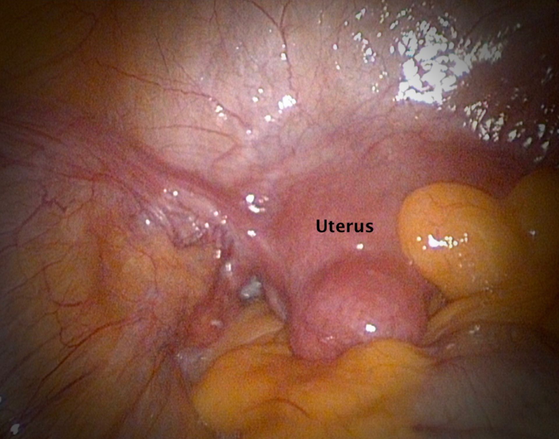 Uterus -Laparoskopie