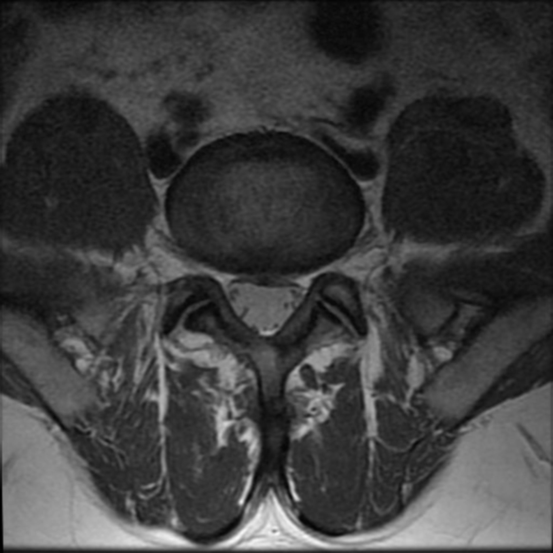 MRI scan pelvis
