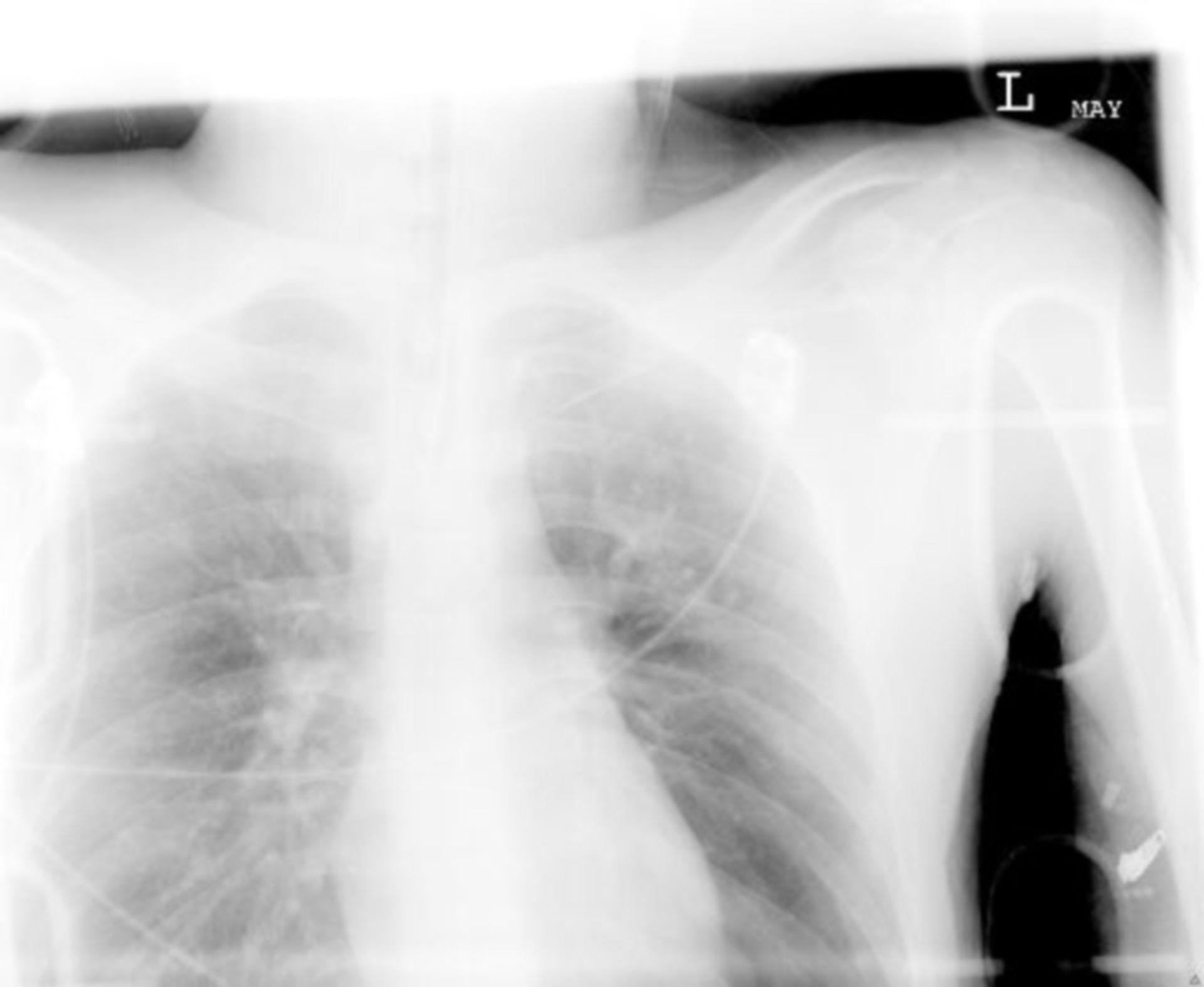 A.-p. Radiografía del tórax, paciente acostado