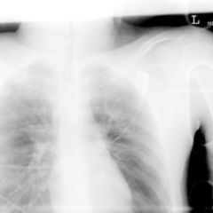 Verschattung - DocCheck Flexikon