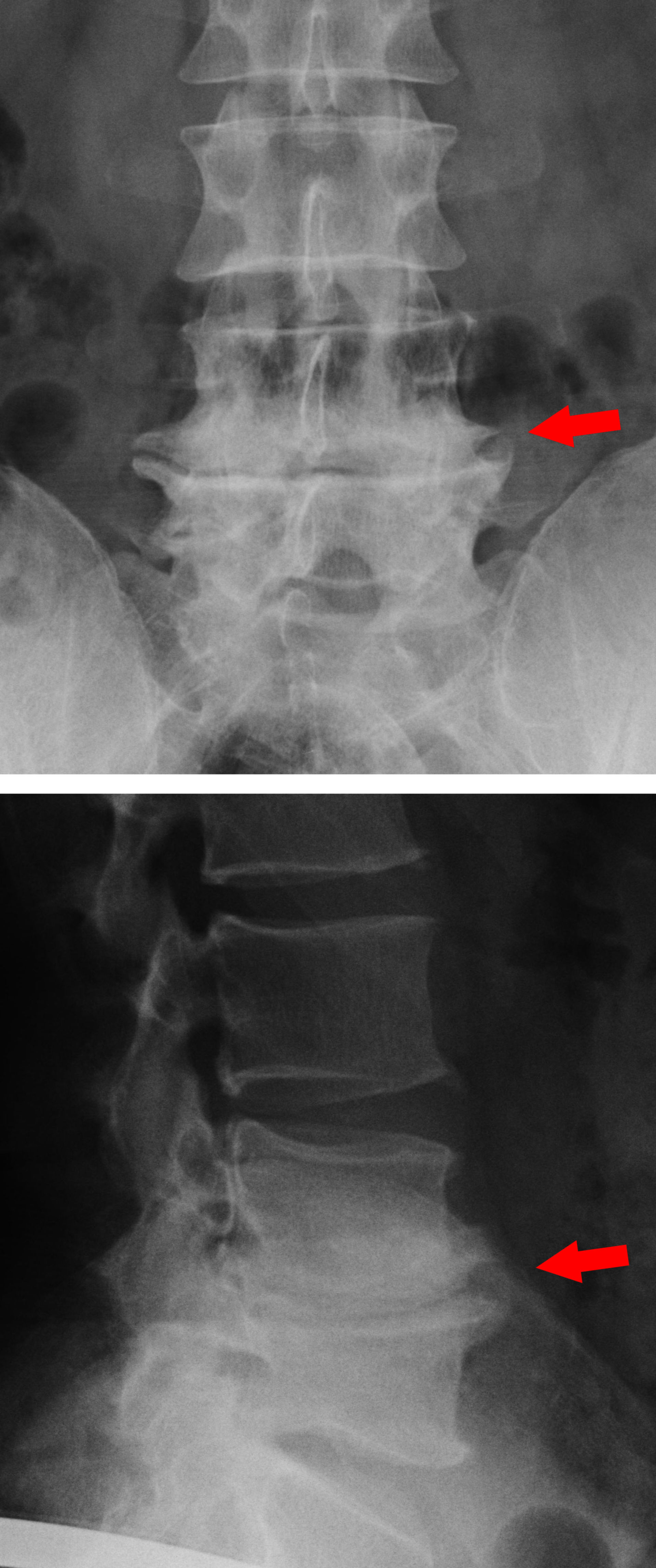 osteochondrosis l4 a nyaki gallér zónájának osteochondrosisa