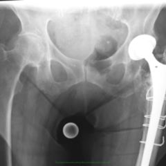 Cerclage DocCheck Flexikon