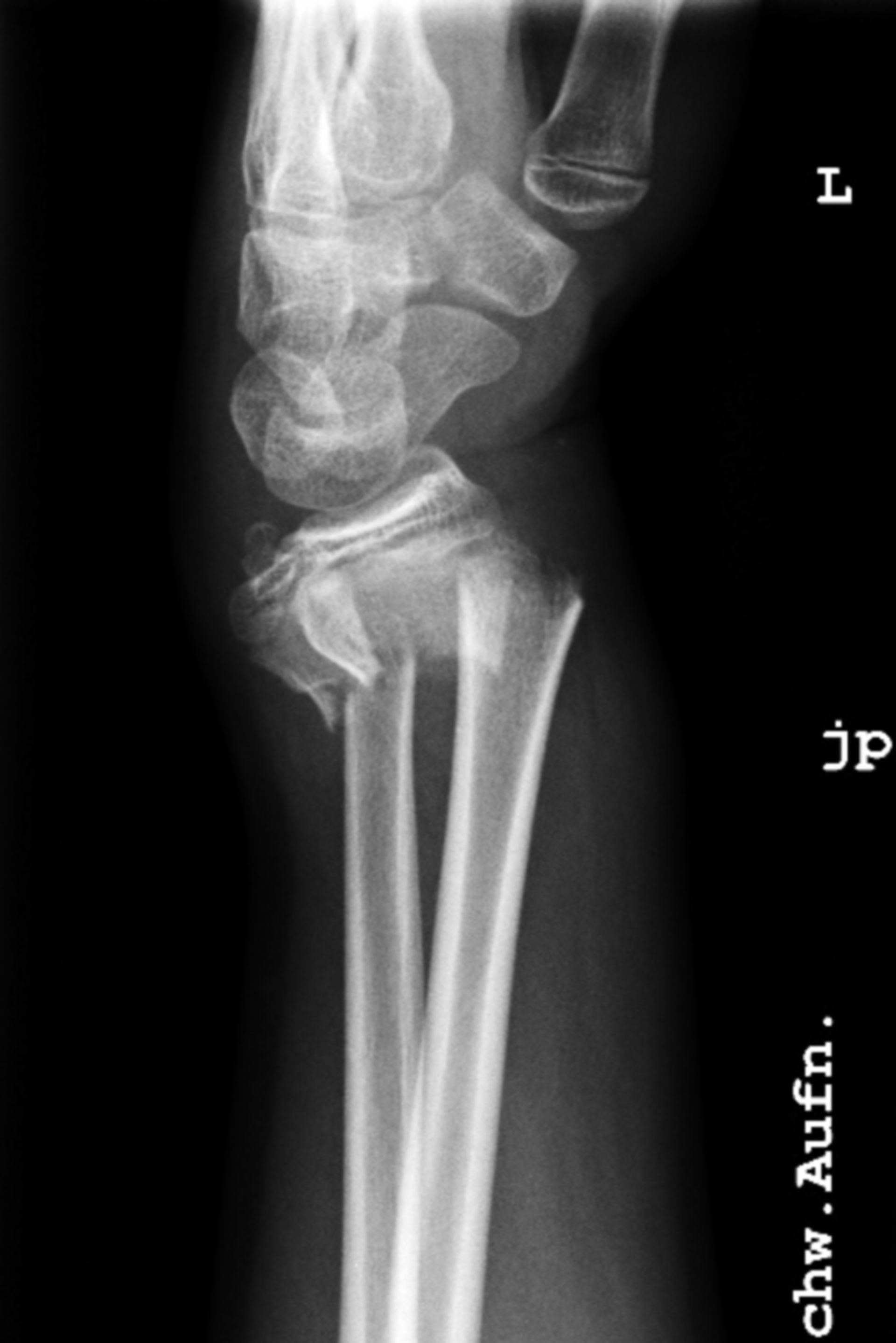 Forearm fracture - child