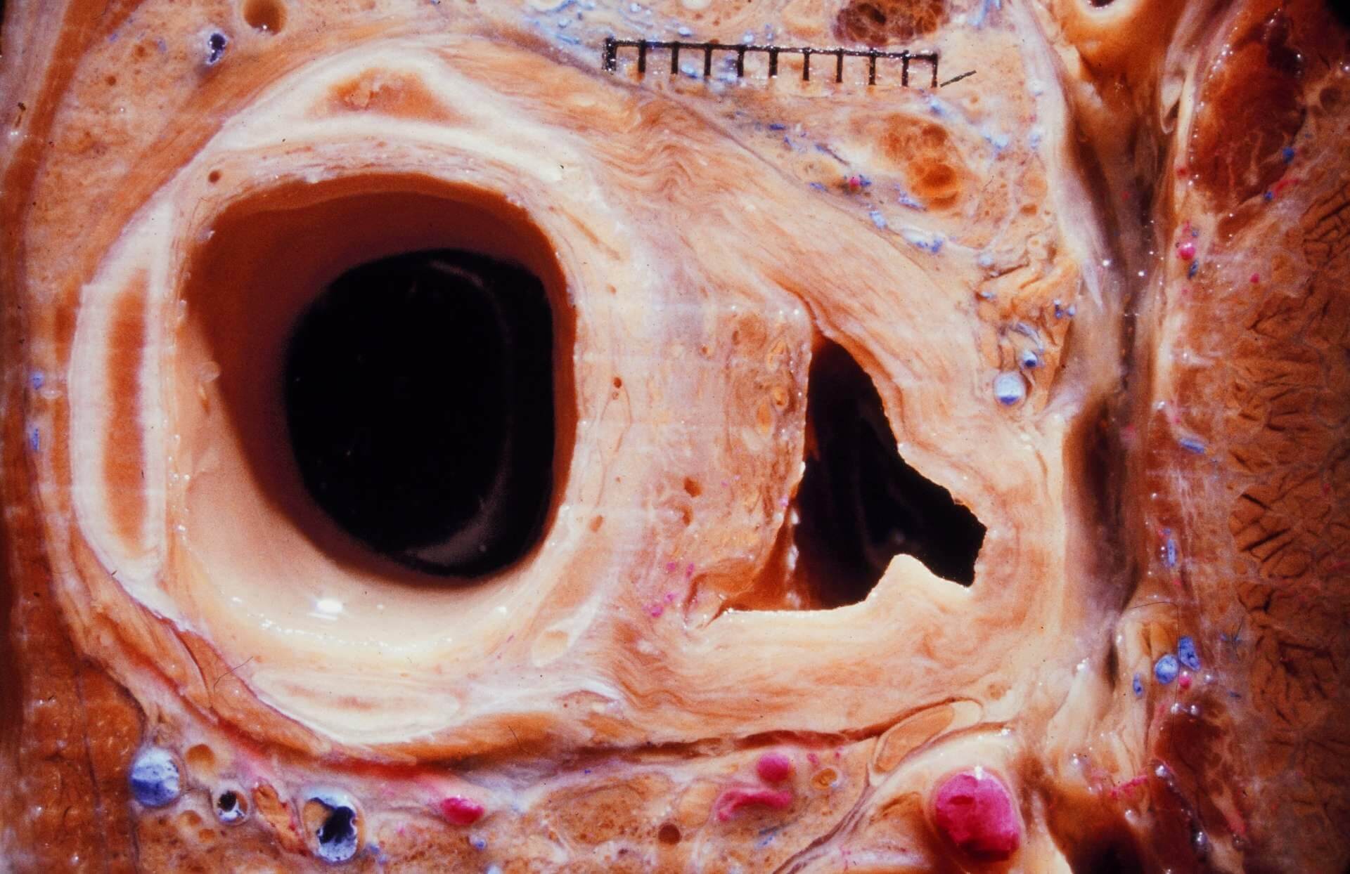 Trachea und Ösophagus