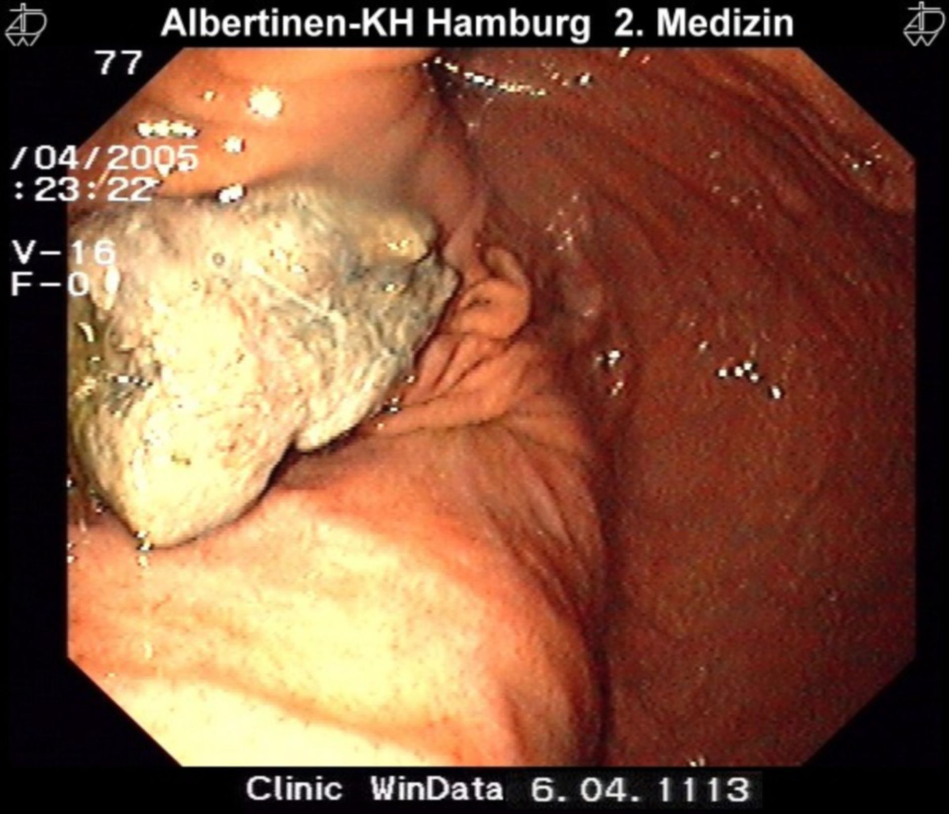 Bolus Oesophagus