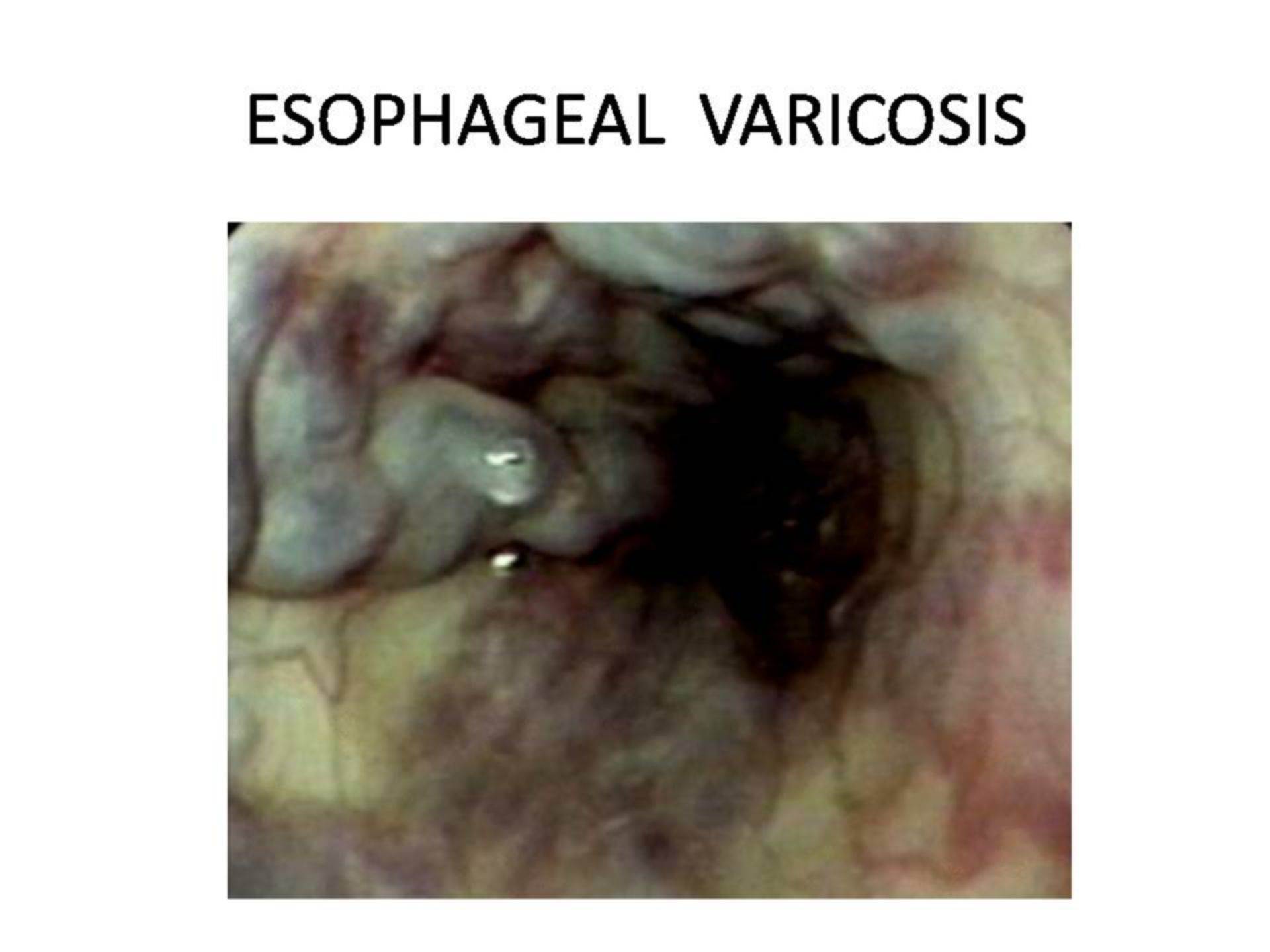 Vene varicose dell'esofago