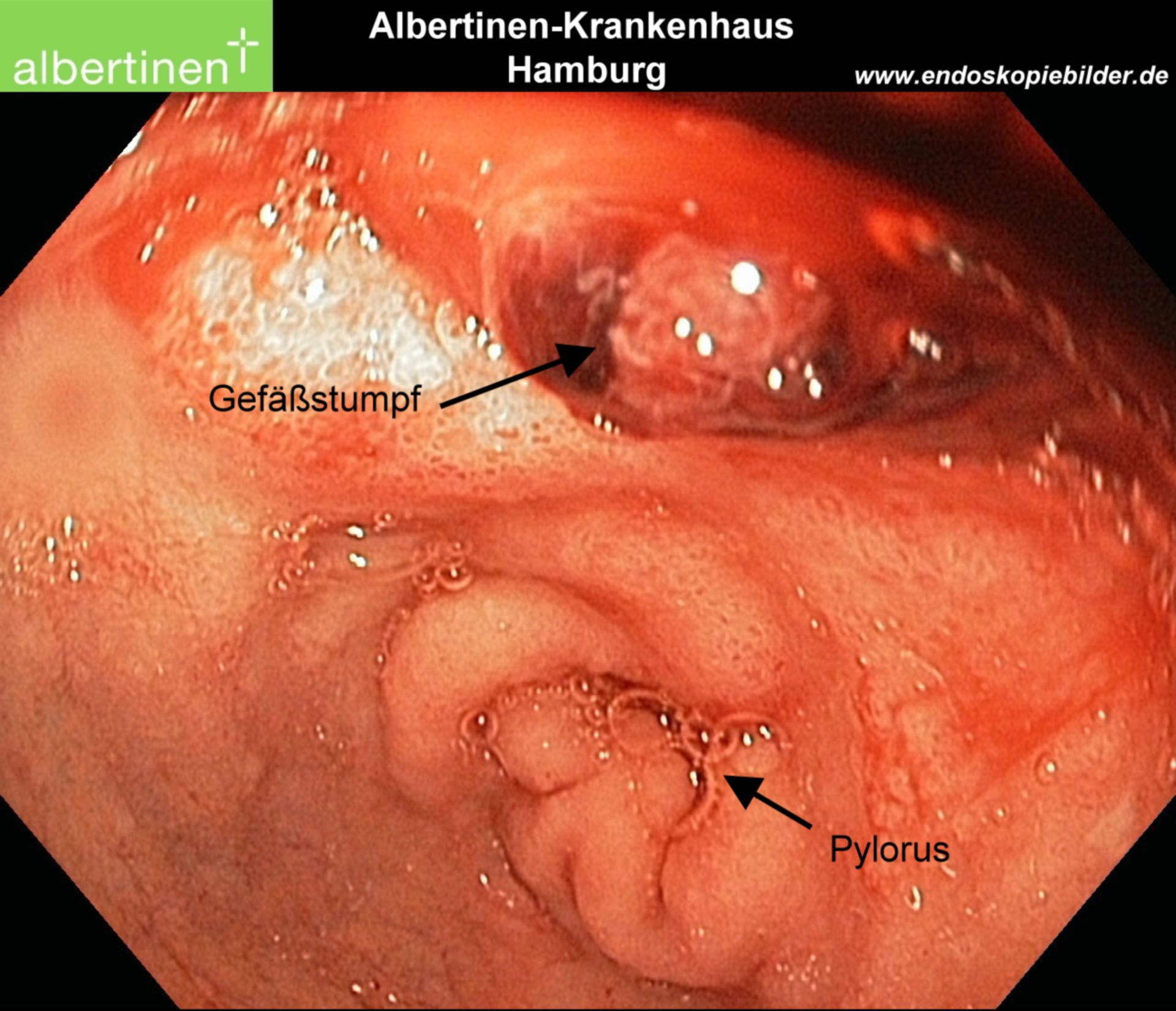 Ulcus-Blutung Magen Endo Pfeile