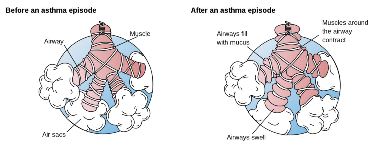 Veränderungen der Luftwege bei Asthmaanfall (Schema)