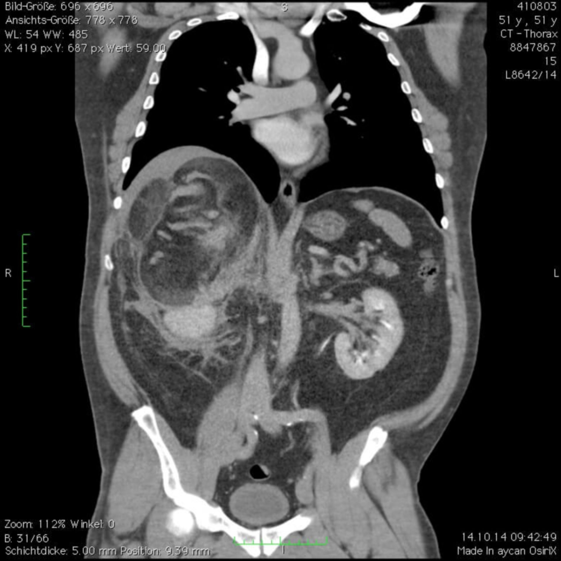 Nebennieren Tumor rechts CT