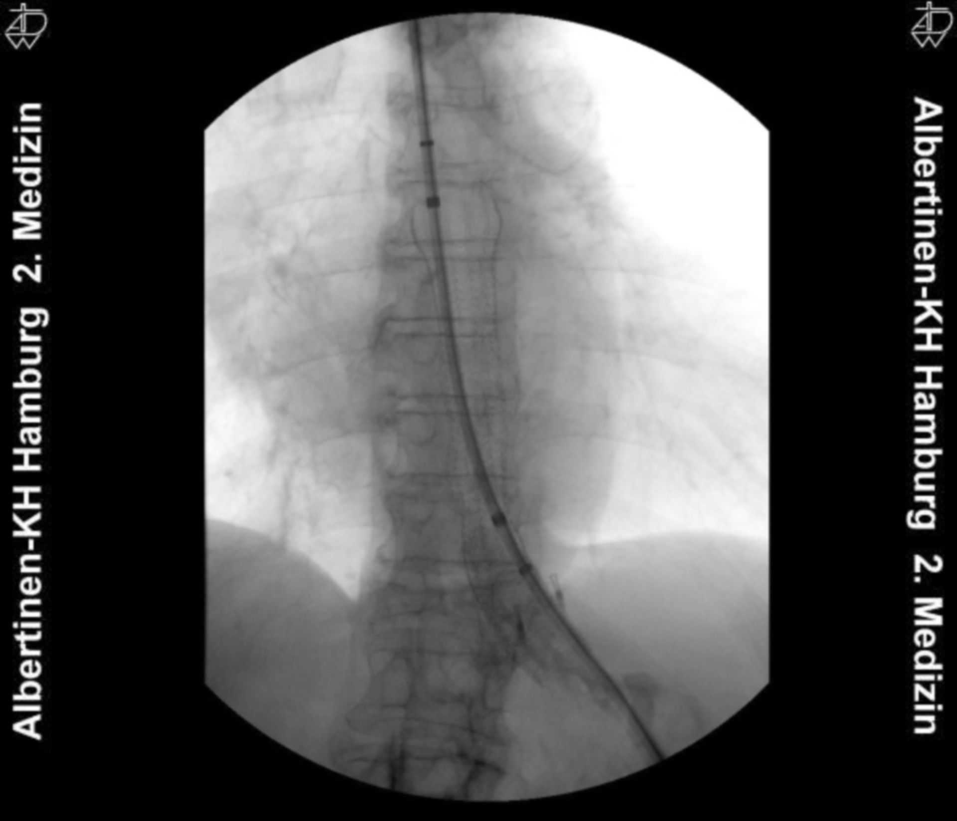 Esophagus stent: Release