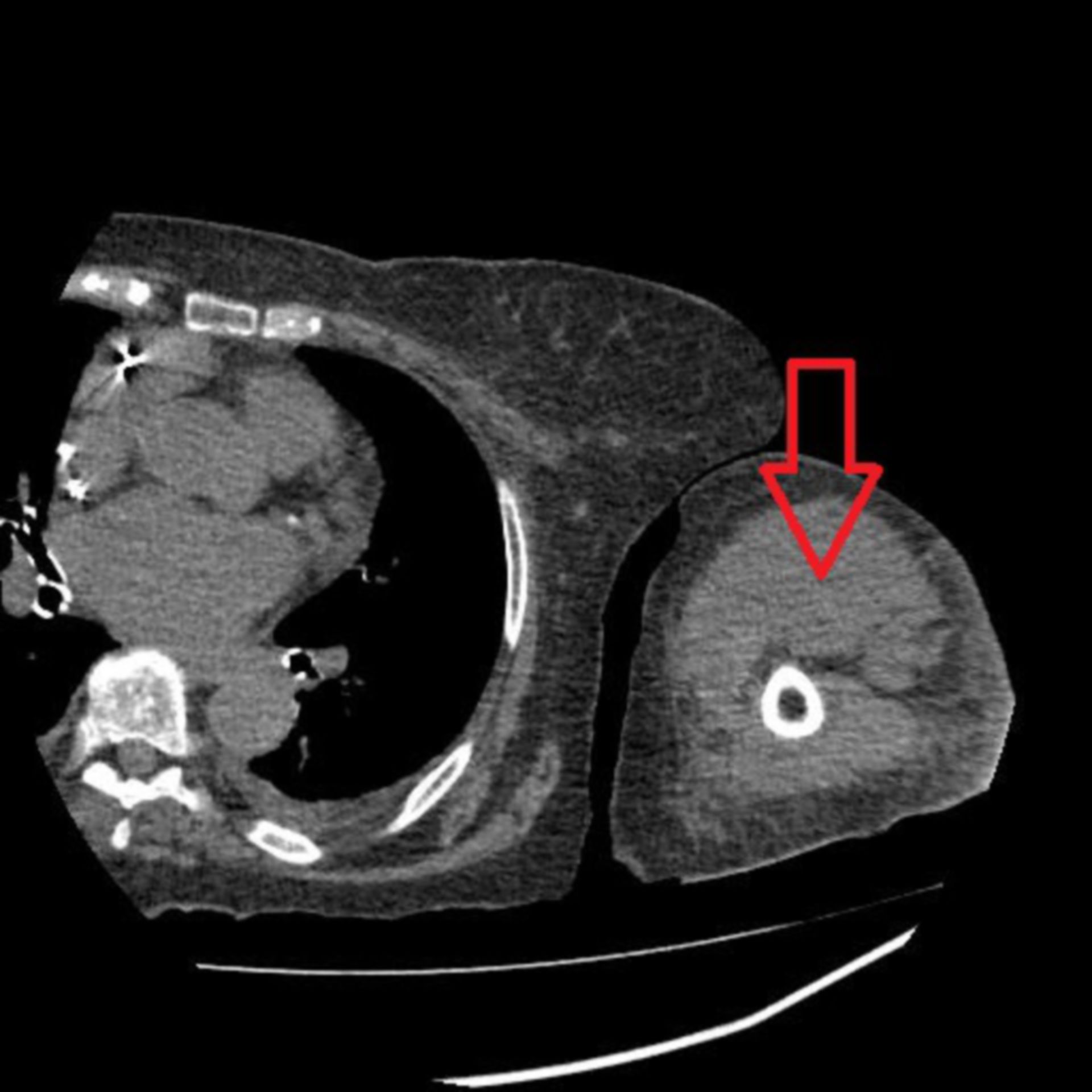 CT des Oberarms in transversaler Ebene mit hyerdenser und homogener Raumforderung ventral des Humerus