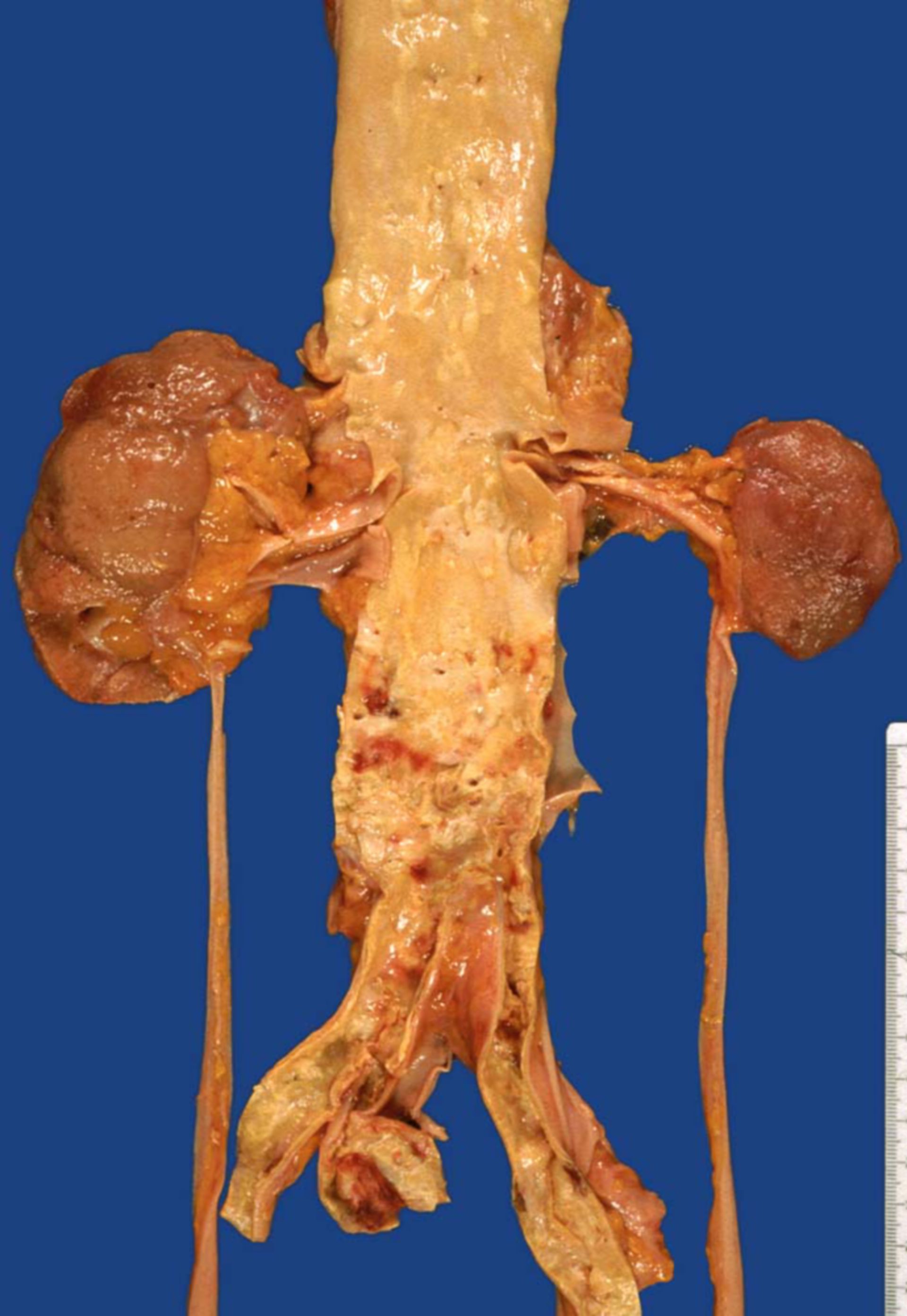 Shrunken kidney - obstruction of right renal artery