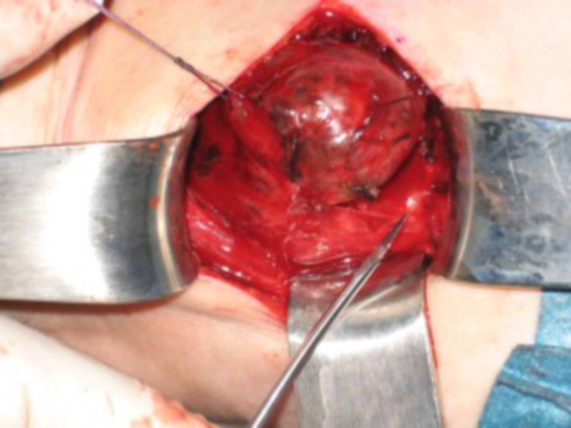Preparazione capsula tiroidea di un malato