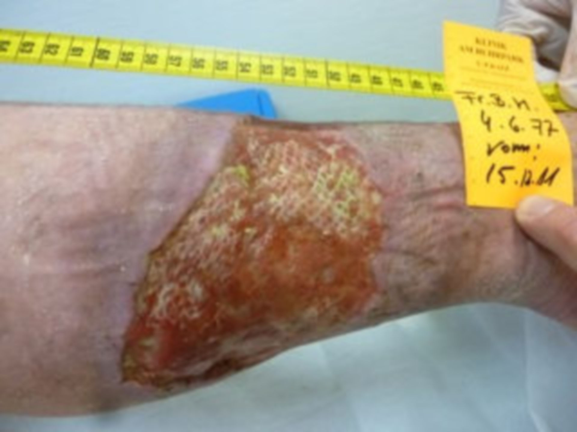 7 years open (22) - 3 days after in-patient admittance