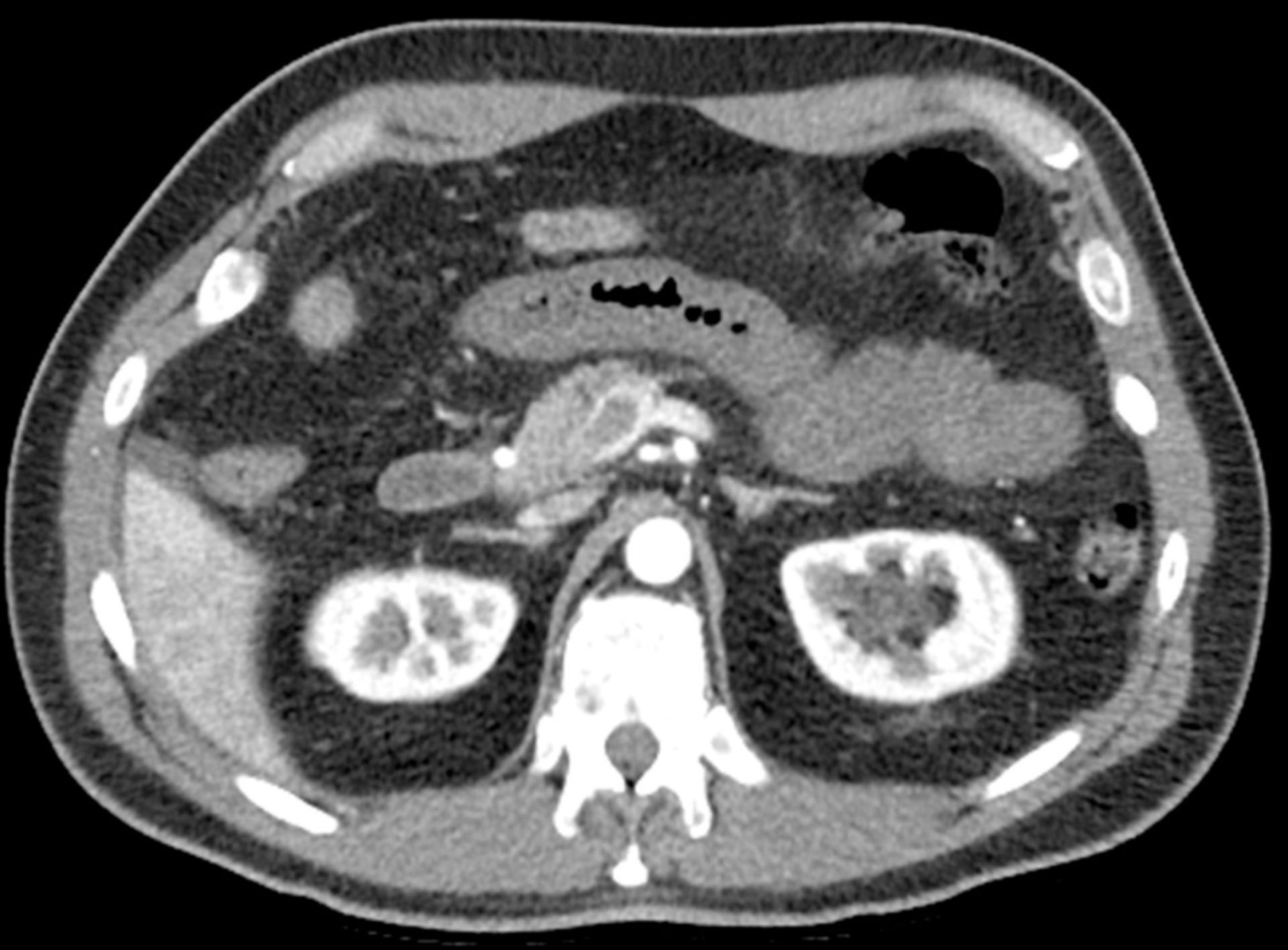 CT des Abdomens in transversaler Ebene mit Mesenterialvenenthrombose