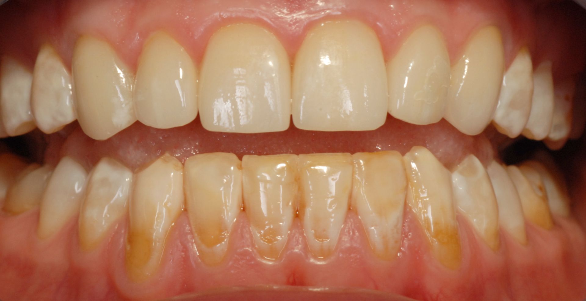 Fluorosis of the mandible