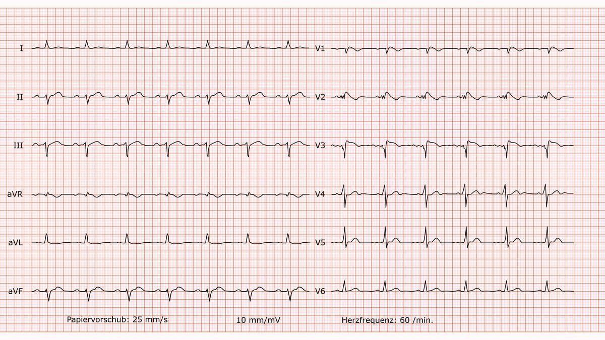 12-Kanal-EKG bei Brugada-Syndrom