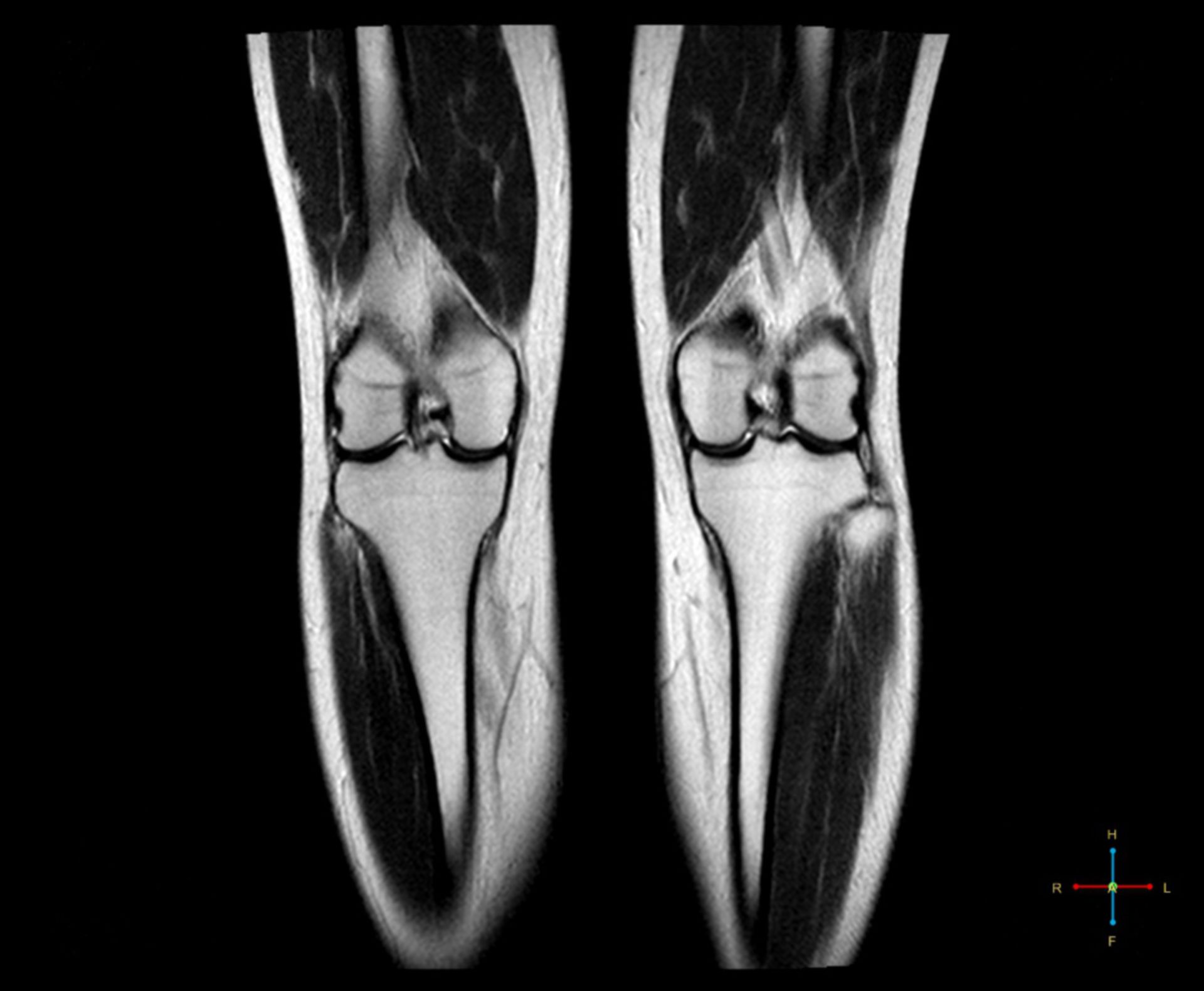 Knee MRI