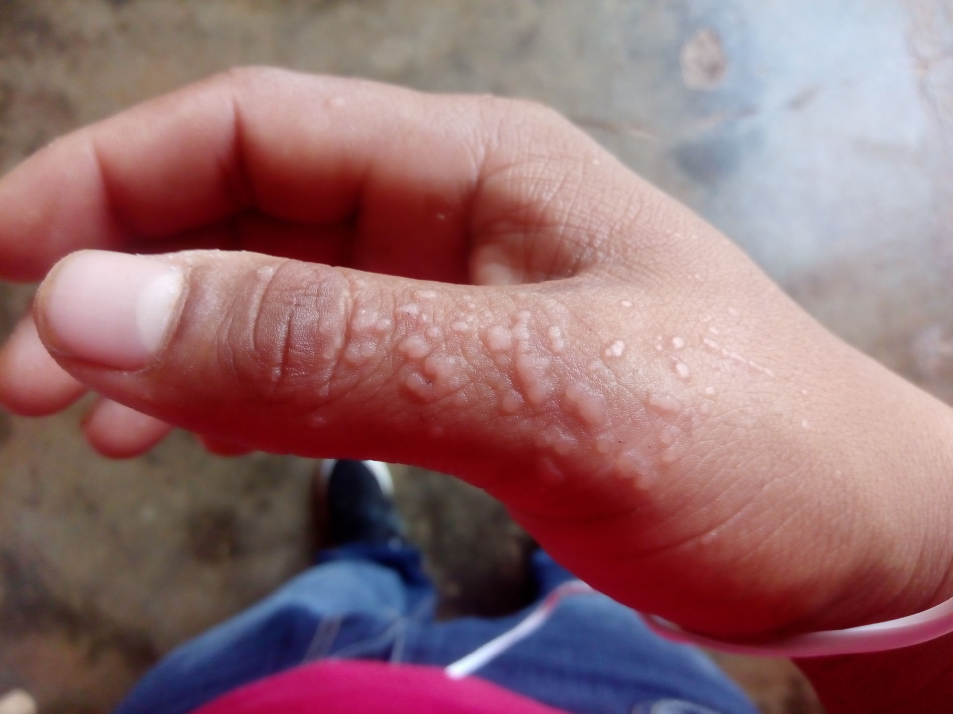 Hand eines jungen Patienten mit Urtikaria