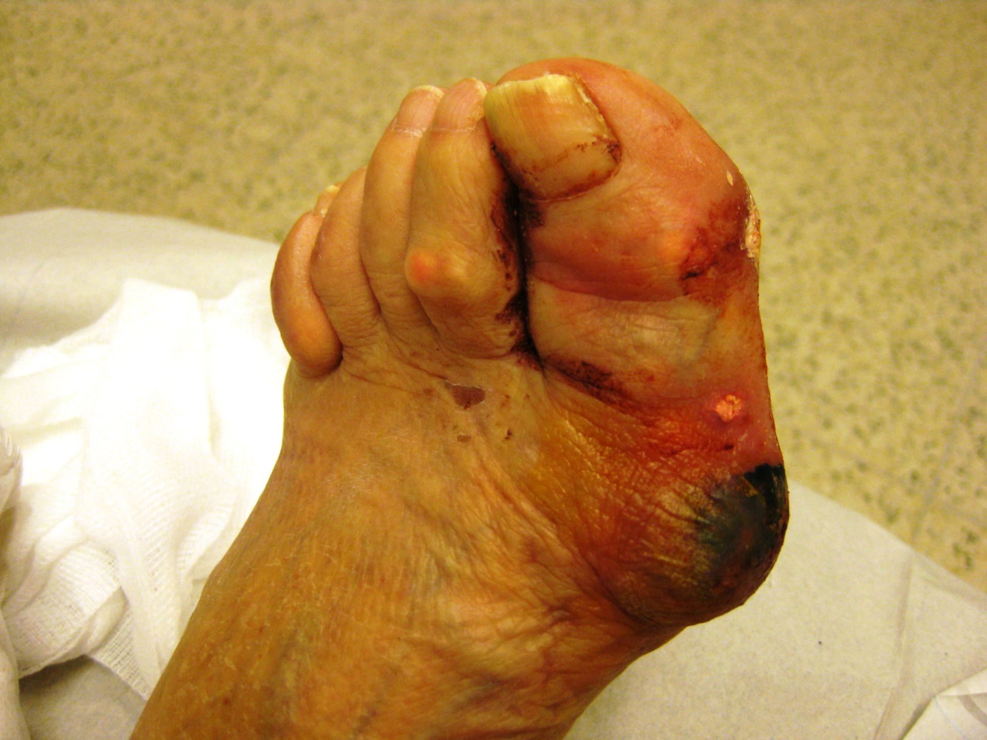 Diabetic foot and gout