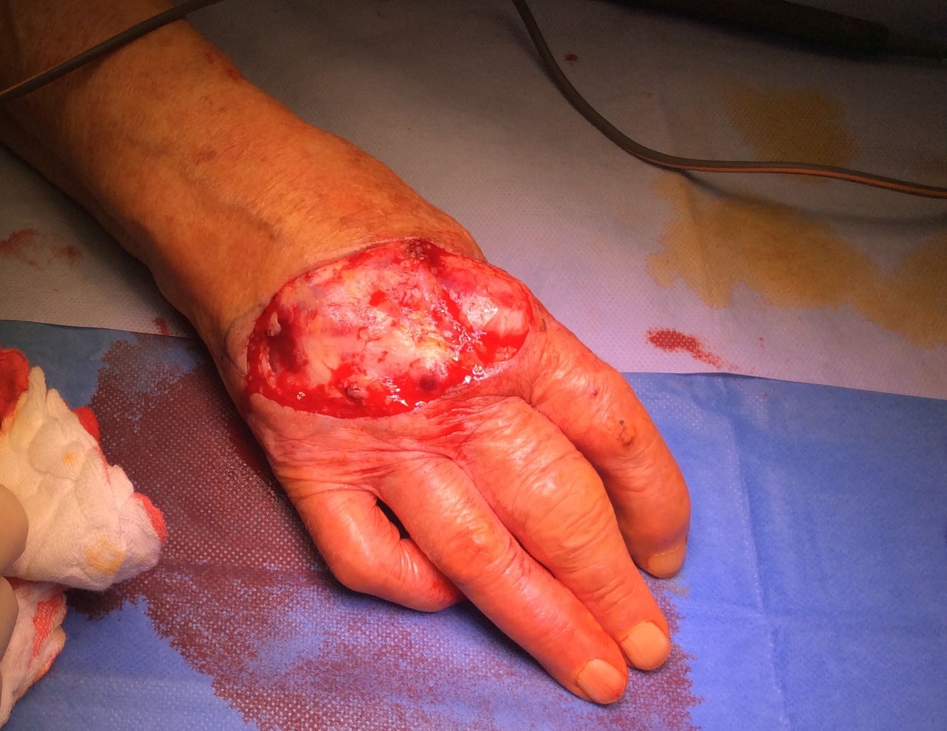 Squamous cell carcinoma of the hand - situs after resection