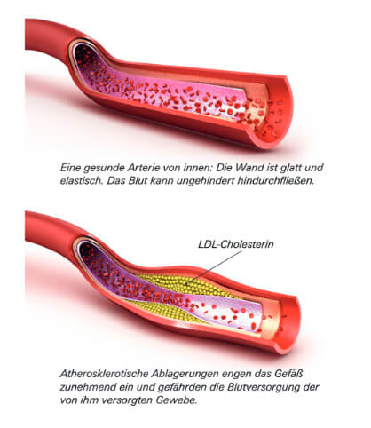 atherosklerose_original.jpg