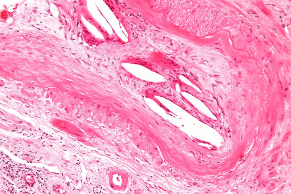 Cholesterinspalte
